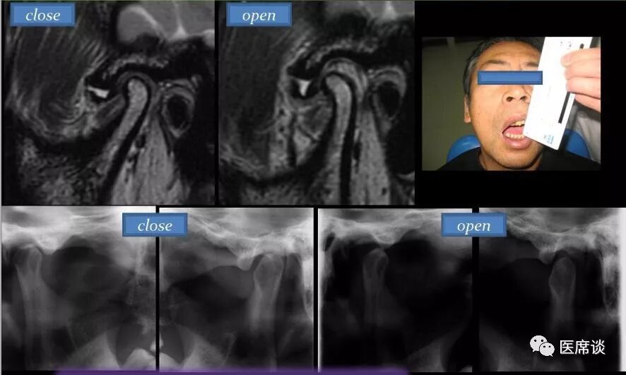 总结:不可复性关节盘前移位影像特点