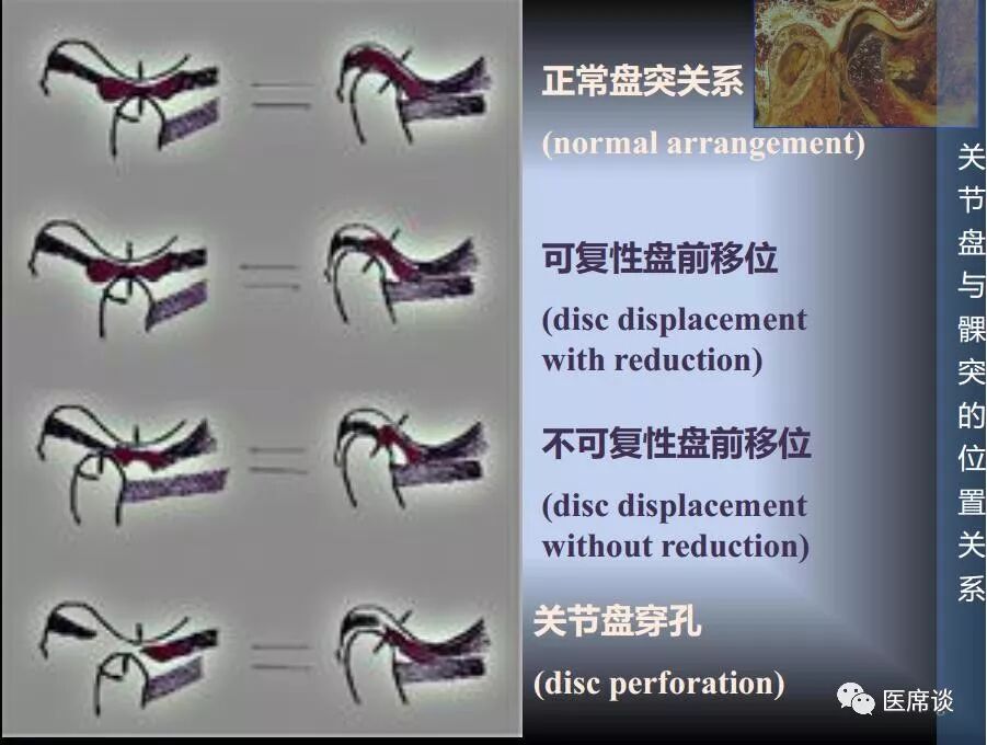颞颌关节紊乱病—解放军总医院口腔外科专业讨论群微信公开课之十一