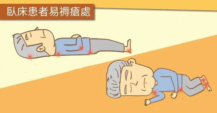 压力的原因:褥疮很多人习惯称为压疮,主要是由于长期受到压力的影响