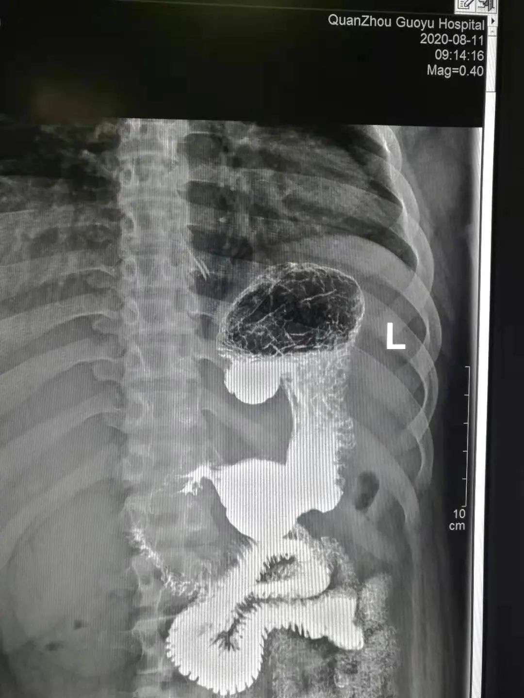 国宇科普胃肠疾病除了做胃镜上消化道钡餐造影也是一种选择
