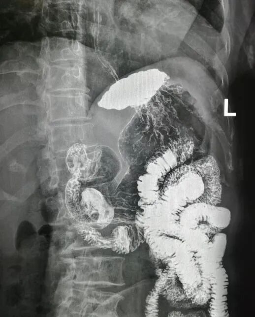 国宇科普胃肠疾病除了做胃镜上消化道钡餐造影也是一种选择