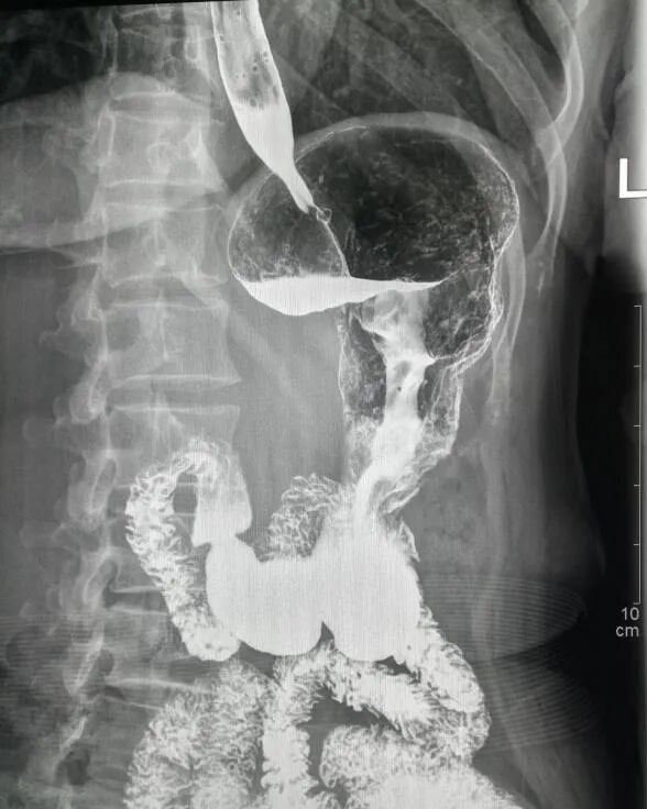 影像诊断:"瀑布型"胃;慢性胃炎案例 10患者,进行性吞咽困难半年.