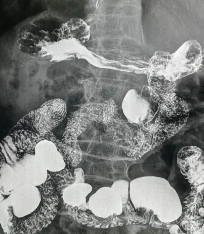 影像诊断:十二指肠球部溃疡案例 8影像诊断:胃底后倒("瀑布型"胃)案例