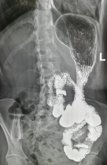 国宇科普胃肠疾病除了做胃镜上消化道钡餐造影也是一种选择