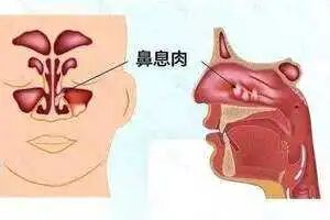 【鼻炎】不注重鼻息肉有什么后果？