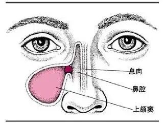 【鼻炎】急性鼻窦炎的症状和危害，你了解多少？