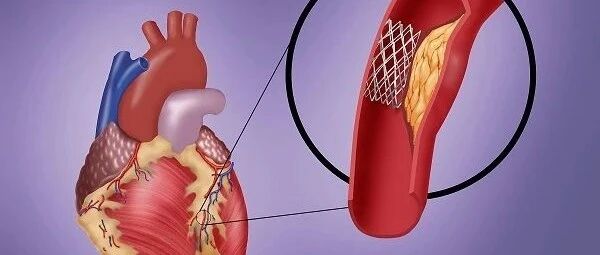​心脏支架从1.3万跌到700元 价格跳水背后你不知道的知识