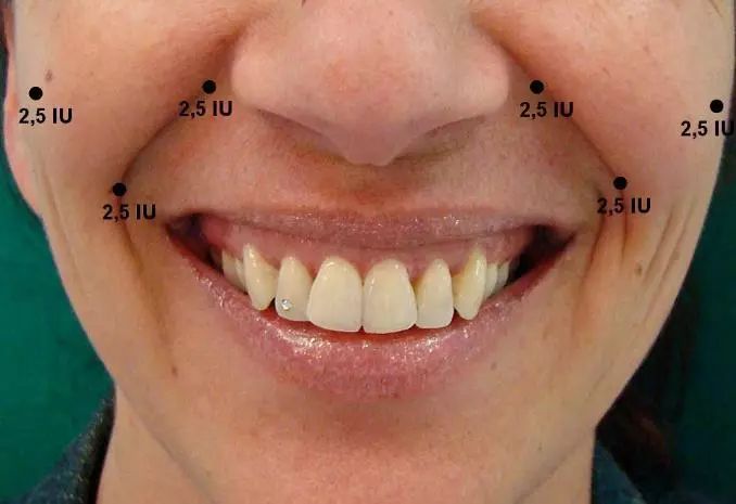 常用注射部位为颧区两点,第一点为用力微笑时,笑纹最外侧段(即颧大小