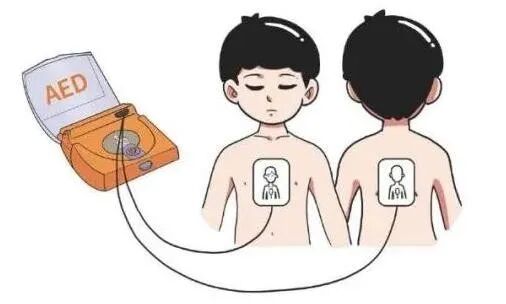 aed电极贴怎么贴应急科普——“救命神器”AED_https://www.jmylbn.com_新闻资讯_第12张