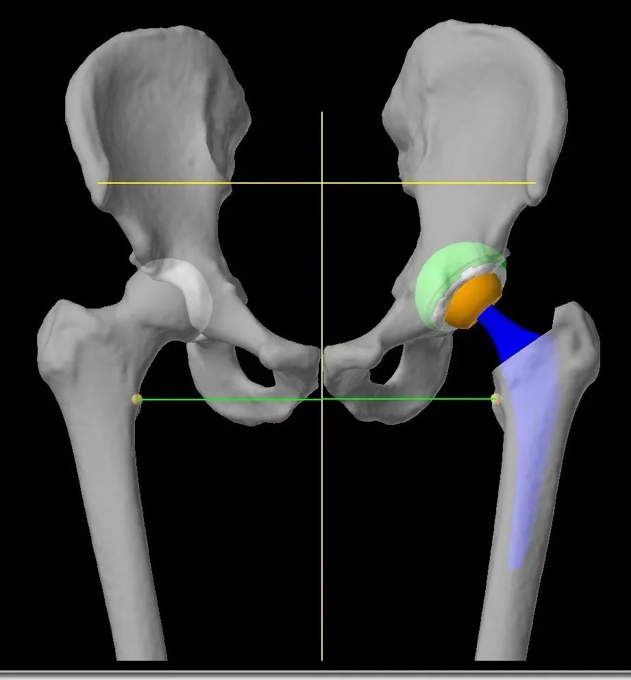 医心医意 | 守护关节健康，科学应对股骨头缺血坏死