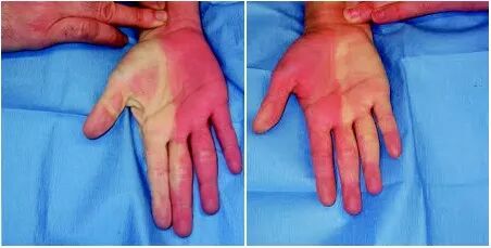 动脉长鞘怎么置入【临床知识】桡动脉穿刺技巧细节要知道_https://www.jmylbn.com_新闻资讯_第6张