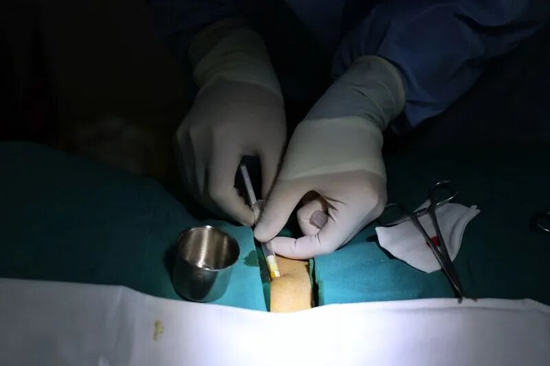 北京首例“戒酒芯片”手术完成：一次效力超150天，让喝酒变得“不那么快乐”(图3)