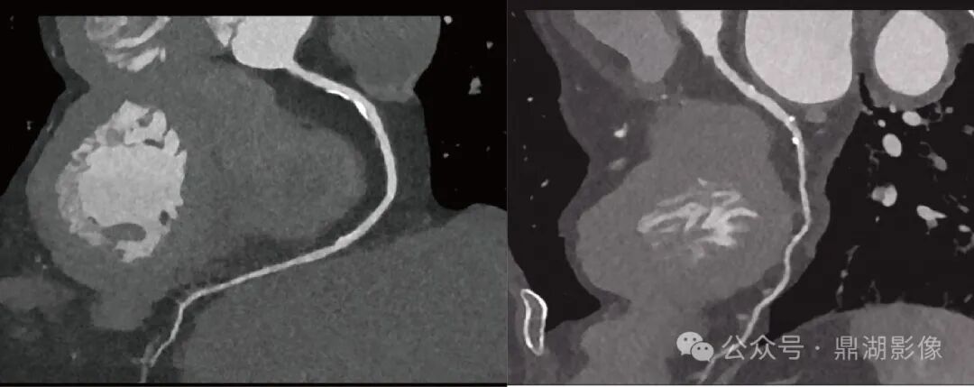 国产的医用ct有哪些国产“双”光子CT横空出世！国产超高端CT的“王炸”来了！_https://www.jmylbn.com_新闻资讯_第8张