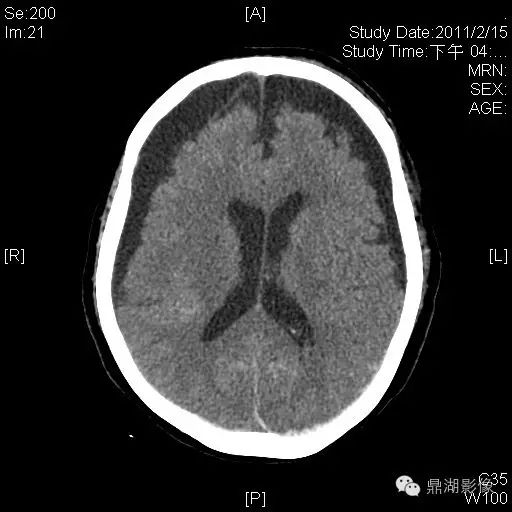 腦萎縮與硬膜下積液_醫學界-助力醫生臨床決策和職業成長