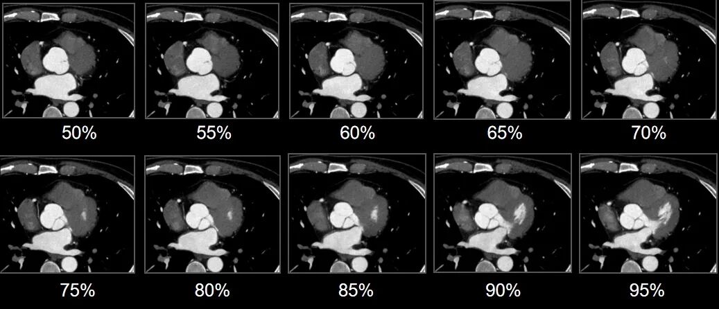什么是联影ct真香预警？联影医疗双宽体双源CT大揭秘！TA竟然可以看到心脏的高清运动！_https://www.jmylbn.com_新闻资讯_第19张