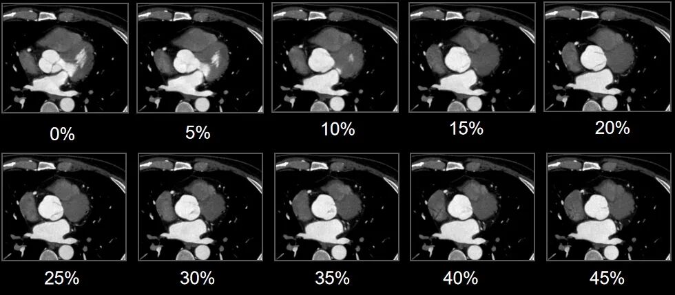 什么是联影ct真香预警？联影医疗双宽体双源CT大揭秘！TA竟然可以看到心脏的高清运动！_https://www.jmylbn.com_新闻资讯_第18张