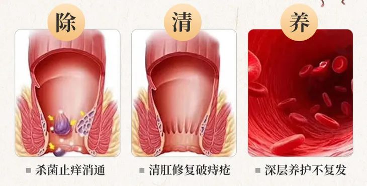 痔疮自愈3个小偏方，不打针、不吃药，坚持1个月以上的人都好了