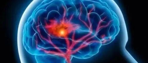 50岁以上人群该如何预防中风？千万别忽视！