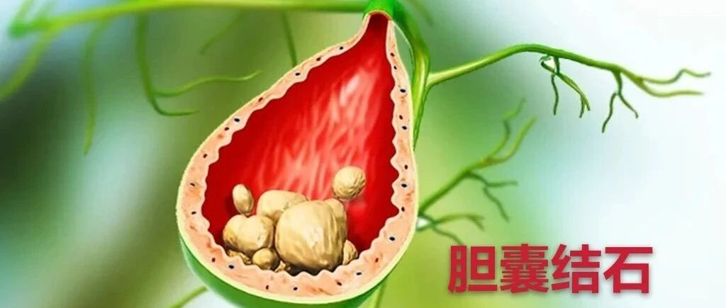 反复腹痛腹胀、嗳气？慢性胆囊炎才应该是“背锅侠”！