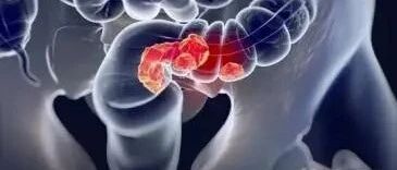 出现这几个症状，警惕！怕是已经“躺中”这两种特殊的肛瘘！