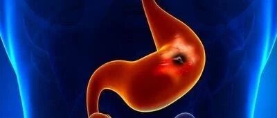 肠上皮化生＝癌变？真相还是谣言？