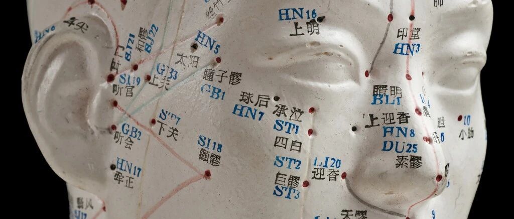 【案例详解】中医治疗头痛，“针”行！