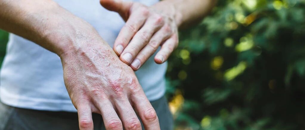 男子外出游玩被虫咬后发热、呼吸急促险丧命！这些防范知识一定要知道