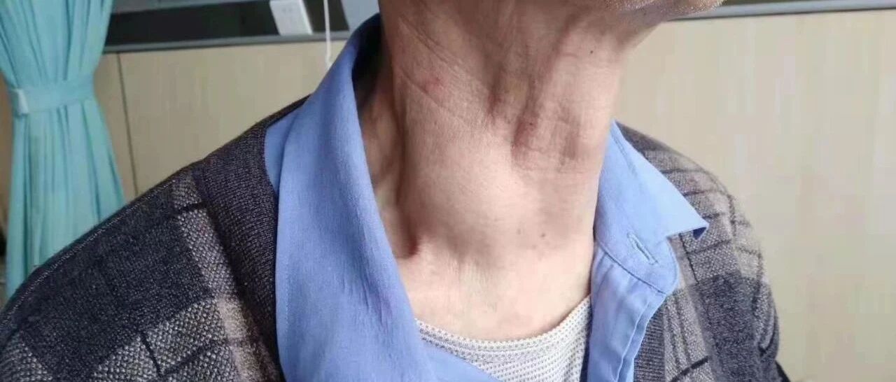 【解密】甲乳疝外科！它让甲状腺结节和乳腺包块“完美消失”