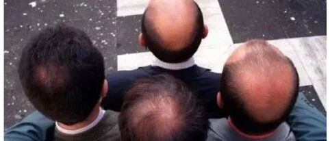 关注你的 “头等大事”——脱发