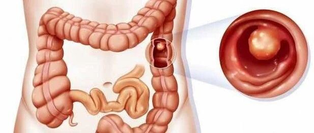 胃肠息肉=癌前病变？此言差矣！