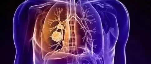 肺部发现结节一定是肺癌么？关于肺结节的那些事儿