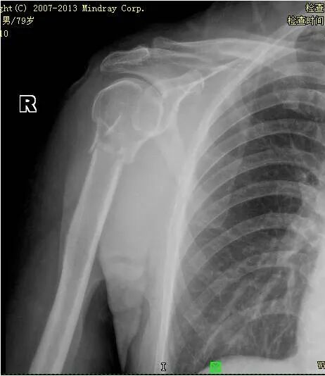 医用骨夹板怎么用骨折了手术治疗or保守治疗？小小夹板来助力_https://www.jmylbn.com_新闻资讯_第7张