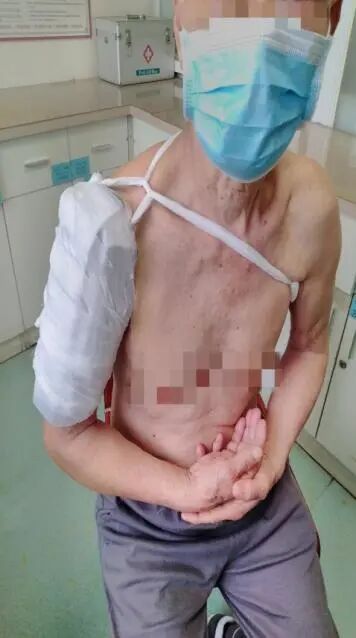 医用骨夹板怎么用骨折了手术治疗or保守治疗？小小夹板来助力_https://www.jmylbn.com_新闻资讯_第9张