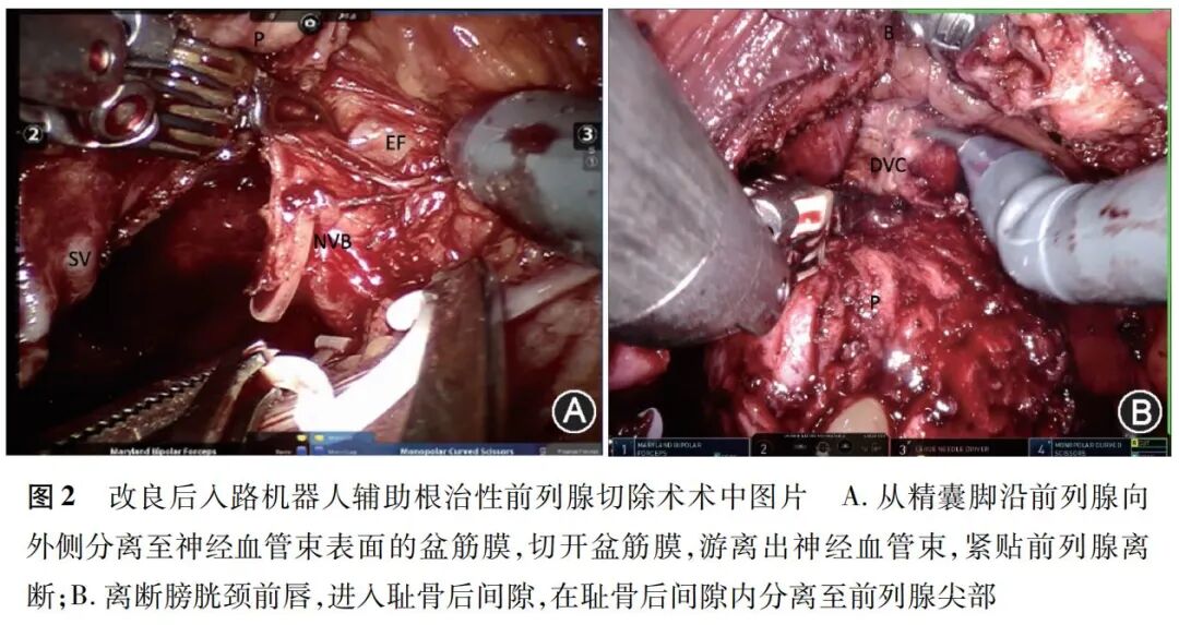 前列腺机器怎么治疗【临床研究】改良后入路机器人辅助根治性前列腺切除术治疗移行带前列腺癌的安全性和疗效_https://www.jmylbn.com_新闻资讯_第6张