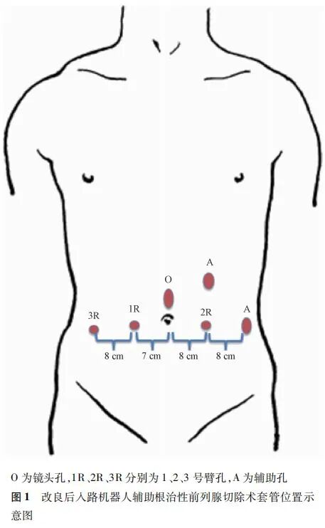前列腺机器怎么治疗【临床研究】改良后入路机器人辅助根治性前列腺切除术治疗移行带前列腺癌的安全性和疗效_https://www.jmylbn.com_新闻资讯_第5张