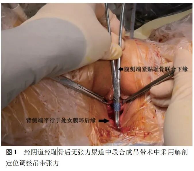 尿道张力过强怎么回事【男性尿失禁与上／下尿路功能障碍】RMUS术中通过解剖定位调整中段尿道吊带张力治疗尿失禁的疗效分析_https://www.jmylbn.com_新闻资讯_第5张