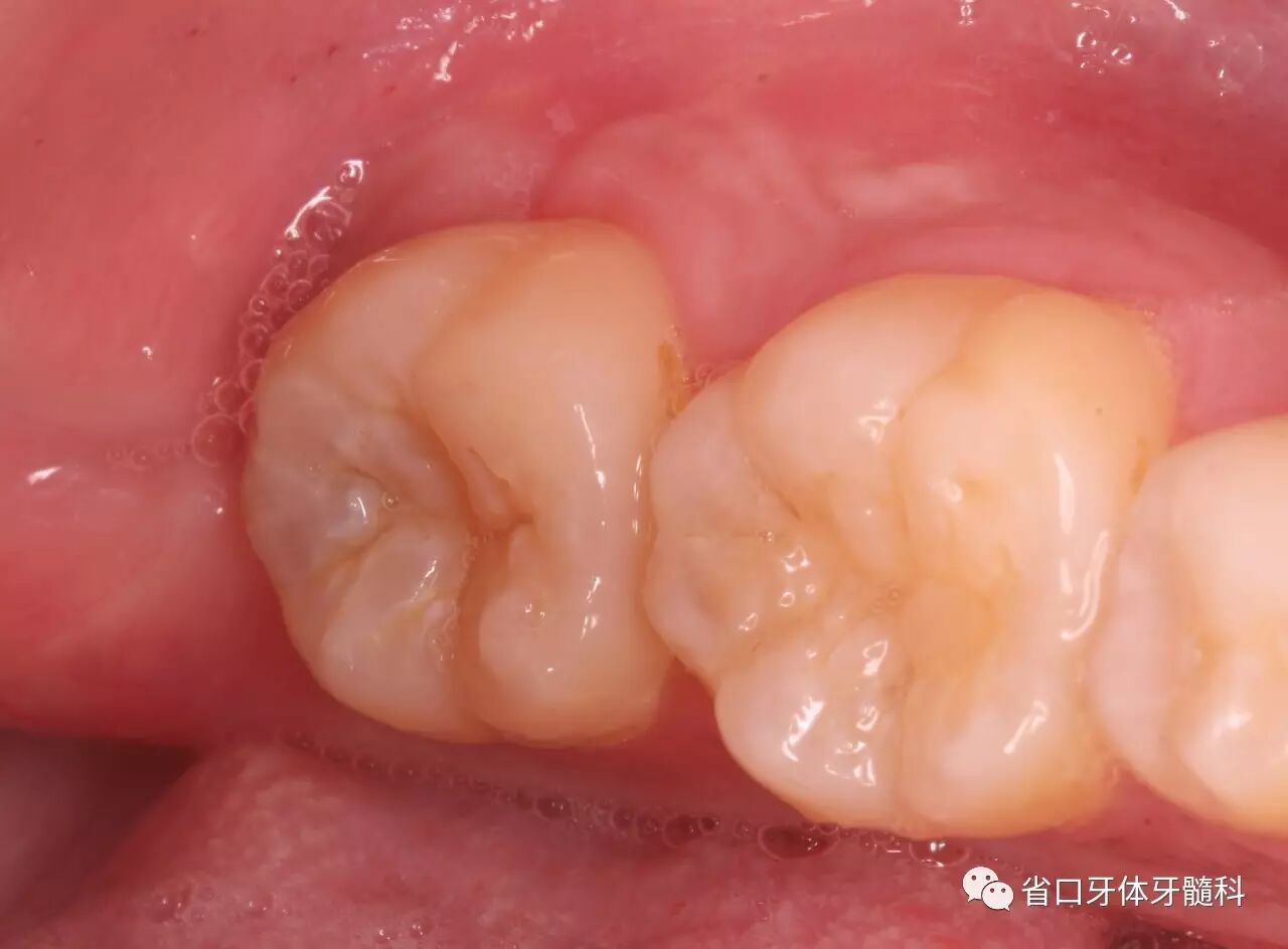 下颌第二磨牙根管治疗术后印章法树脂充填1例
