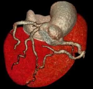 ge ct有哪些型号不怕超重 自由呼吸 ｜ GE Revolution CT显神奇，实现完美冠脉CTA检查！_https://www.jmylbn.com_新闻资讯_第7张