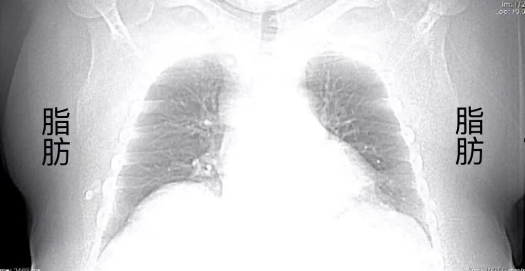 ge ct有哪些型号不怕超重 自由呼吸 ｜ GE Revolution CT显神奇，实现完美冠脉CTA检查！_https://www.jmylbn.com_新闻资讯_第5张