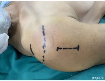 应用解剖型钢板结合肩袖加固技术进行肱骨大结节骨折的微创治疗