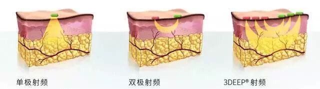 多极射频是什么不花冤枉钱，家用射频美容仪的真相是什么？_https://www.jmylbn.com_新闻资讯_第4张