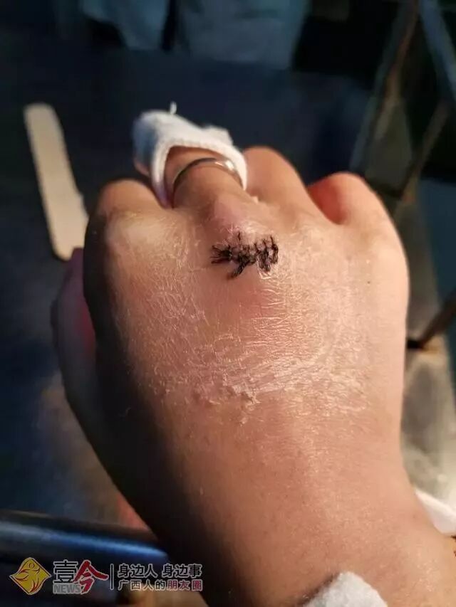 何小姐缝针后的伤口.受访者供图