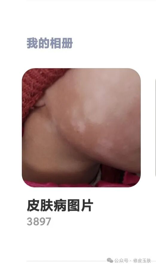 头皮脂溢性皮炎、头皮糠疹、头癣、头皮脂腺痣之间相互鉴别与治疗（皮肤科门诊实图）