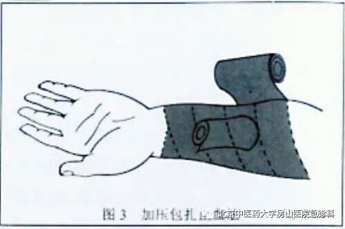 动脉什么压迫止血压迫止血法，您压的方式对了吗？_https://www.jmylbn.com_新闻资讯_第2张