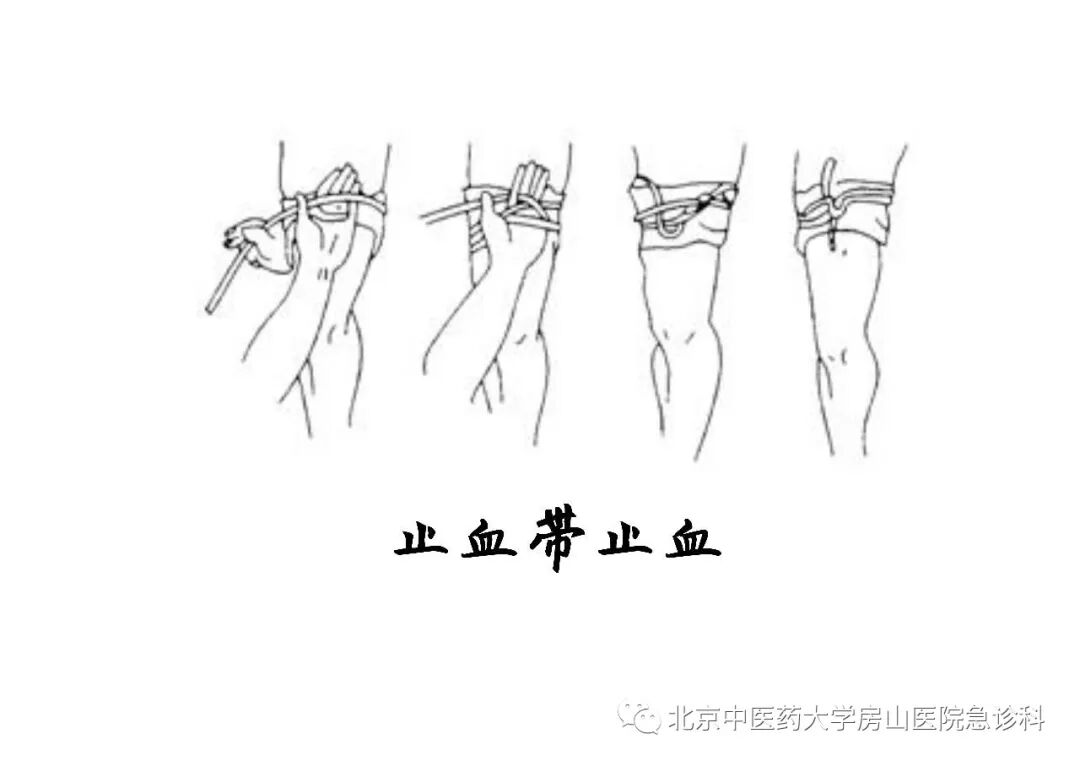 动脉什么压迫止血压迫止血法，您压的方式对了吗？_https://www.jmylbn.com_新闻资讯_第5张