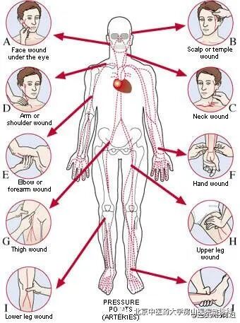 动脉什么压迫止血压迫止血法，您压的方式对了吗？_https://www.jmylbn.com_新闻资讯_第3张