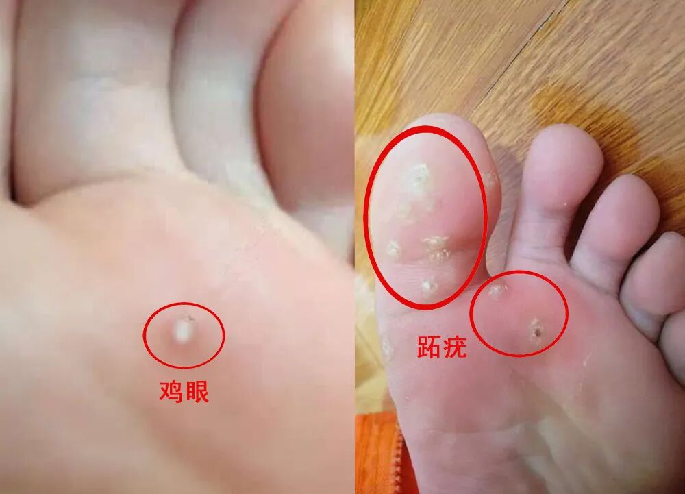 修剪无黑点,不传染;跖疣和鸡眼容易混淆,给大家推荐鉴别的小窍门:老茧