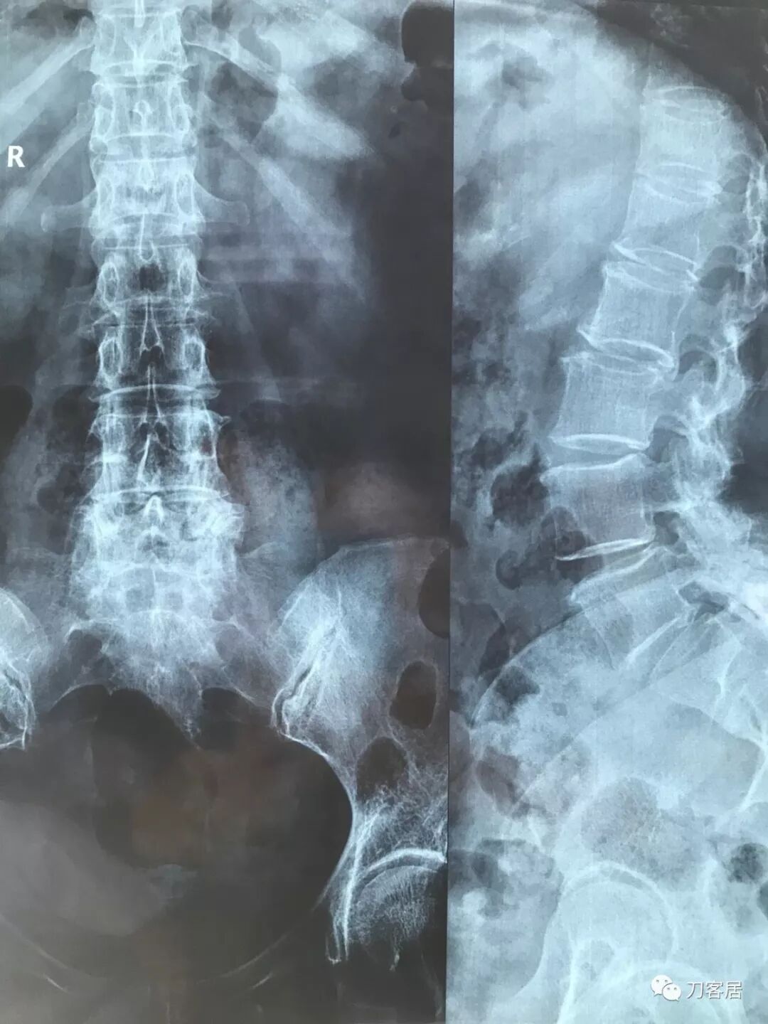 医用阅片灯是什么专业科普！简单又实用的X线片翻拍技术，我只偷偷告诉你_https://www.jmylbn.com_新闻资讯_第19张