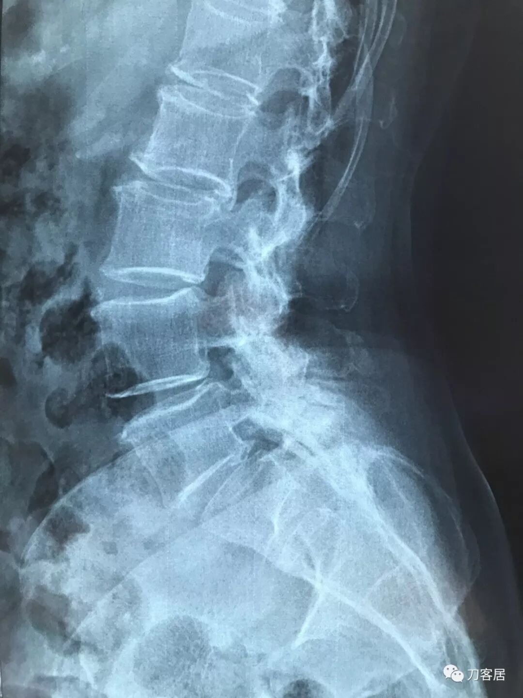 医用阅片灯是什么专业科普！简单又实用的X线片翻拍技术，我只偷偷告诉你_https://www.jmylbn.com_新闻资讯_第21张