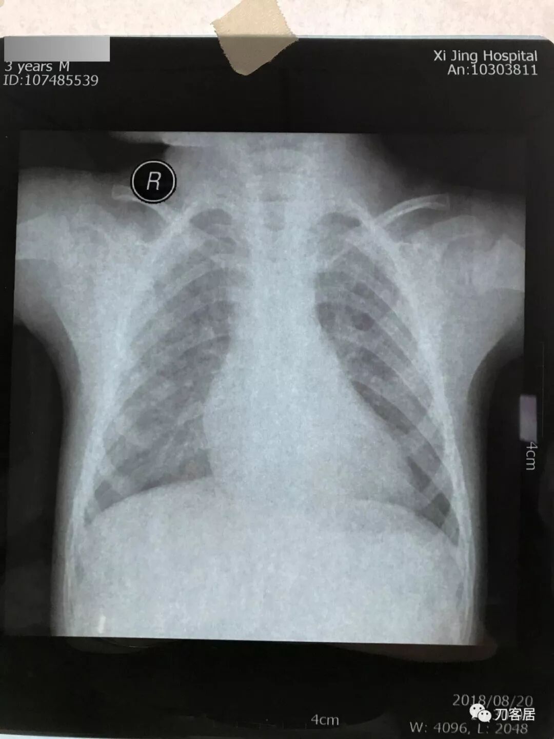 医用阅片灯是什么专业科普！简单又实用的X线片翻拍技术，我只偷偷告诉你_https://www.jmylbn.com_新闻资讯_第17张